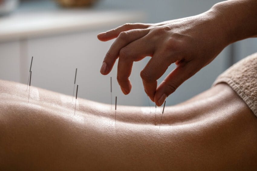 Acupuncture Therapy