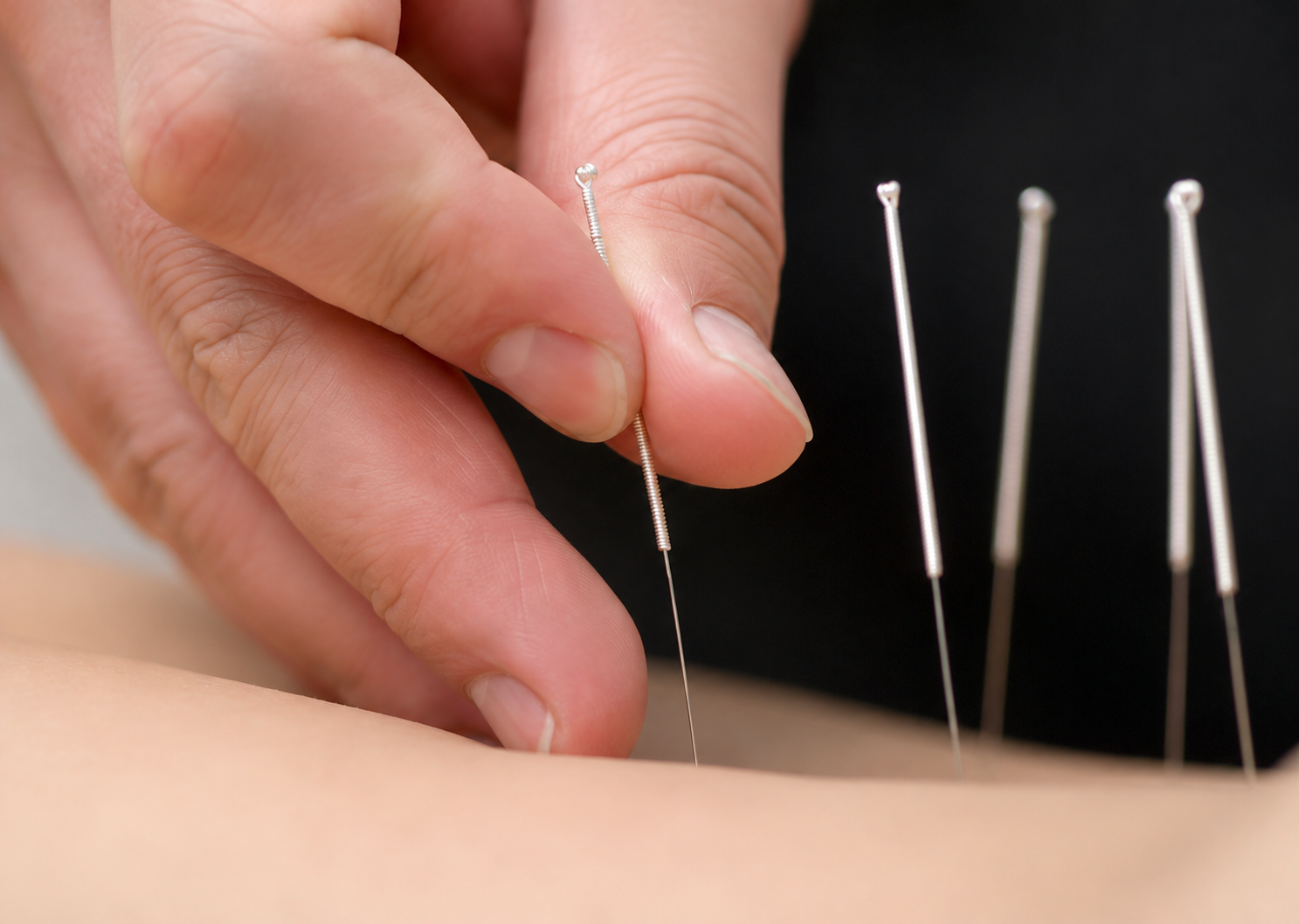 Acupuncture therapy in Chennai — Sun Yoga & Therapy Guduvancheri