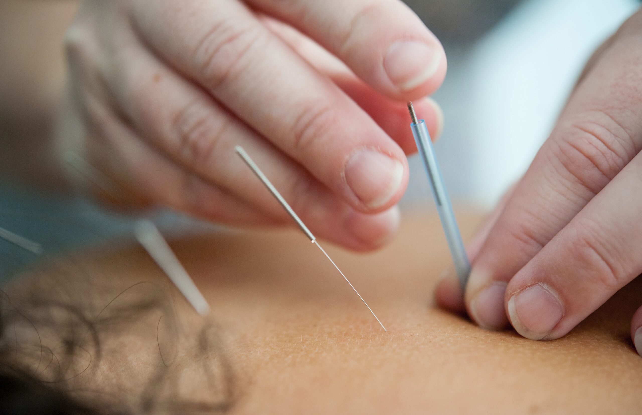 Acupuncture Therapy