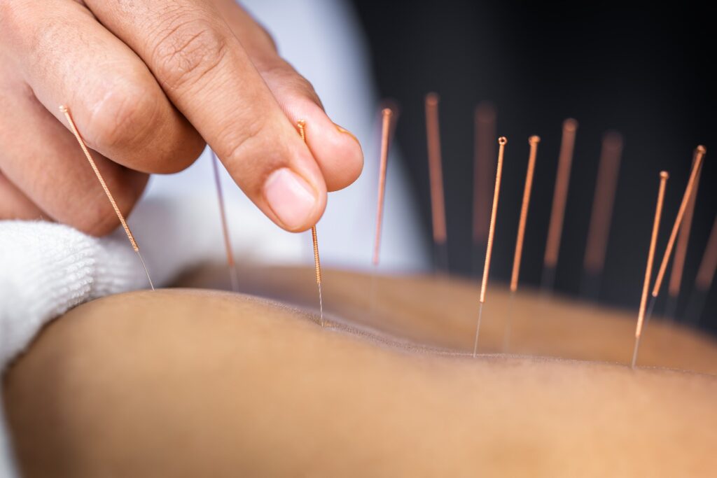 Acupuncture Therapy in Rishikesh